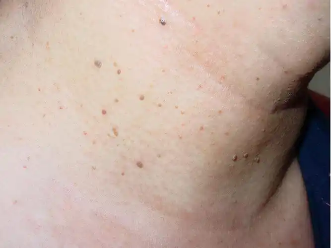 激光去皮赘多少钱(皮肤上的小肉球) - 价格百科