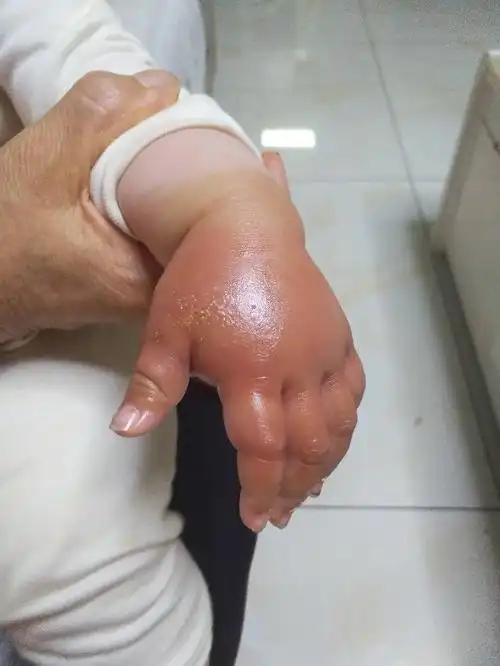 小朋友的手被虫咬了,不知道什么虫,也不知道如何消肿,麻烦懂的朋友