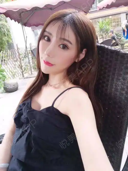 自体脂肪隆胸术后172天_形体填充术后172天_隆胸术后172天_自体脂肪术