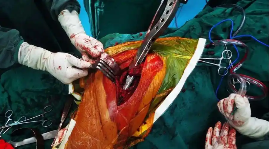 我院骨一科开展超高龄股骨转子间骨折骨水泥加长型人工股骨头置换术