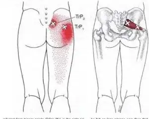 肛门直肠周围疼痛为主的一种症状,屁股疼痛为多种肛门直肠疾病所共有