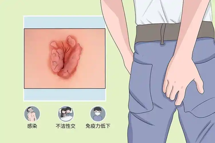 肛门处的"肉疙瘩",不一定是痔疮,也可能是它在捣鬼,别大意_症状_治疗