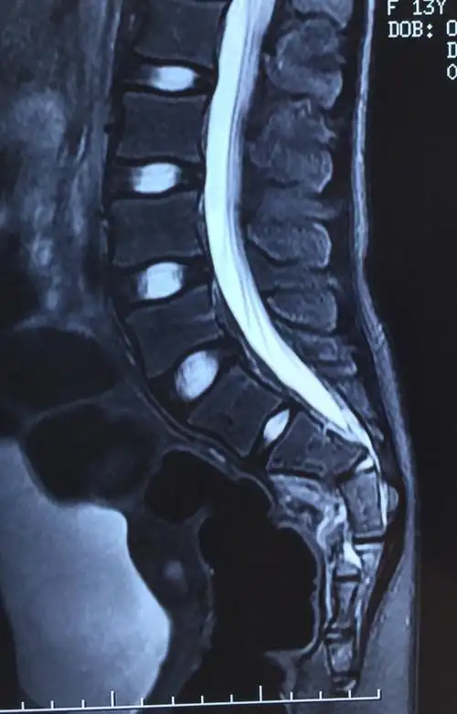 高处坠落伤,骶骨骨折,骶神经损伤---顽固性疼痛和大小便功能障碍_脊柱