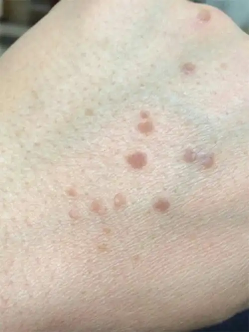 有突发的扁平疣的看过来,教你简单治疗它