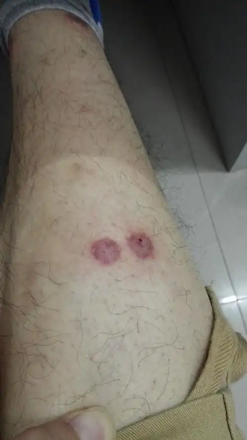 请问腿上起这样的大疙瘩,还发紫是怎么回事,是蚊虫叮咬还是药物过敏