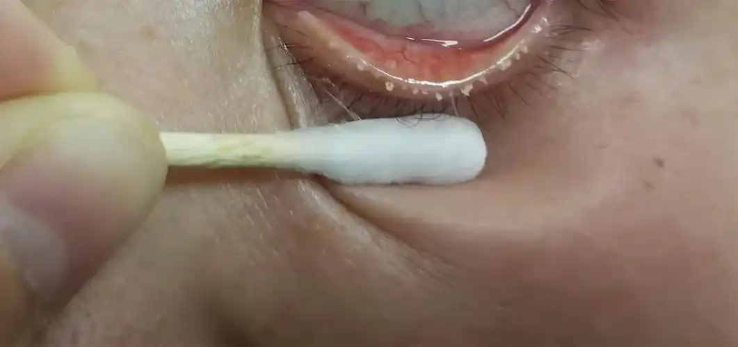 当天先是为小轩进行双眼热敷,联合睑板腺疏通,挤出堵塞的颗粒状分泌物