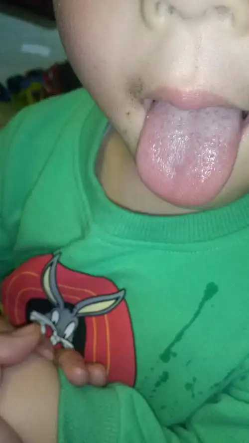 宝宝舌苔白且厚,怎么办