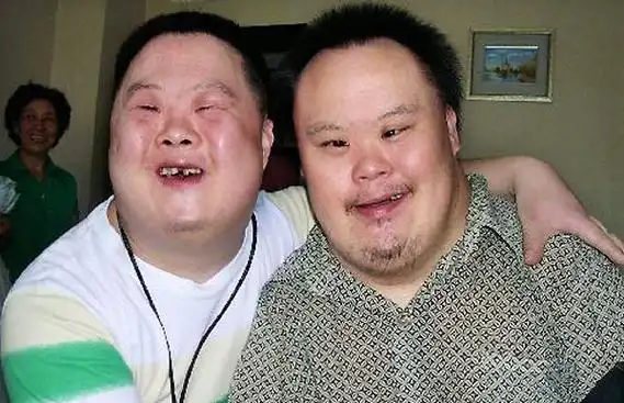 什么是唐氏综合征患儿图片(唐氏儿0-3个月特征) - 读书笔记