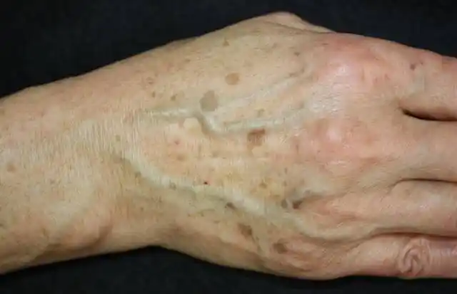 老年斑有可能会发生癌变?预防淡化老年斑,只需1招