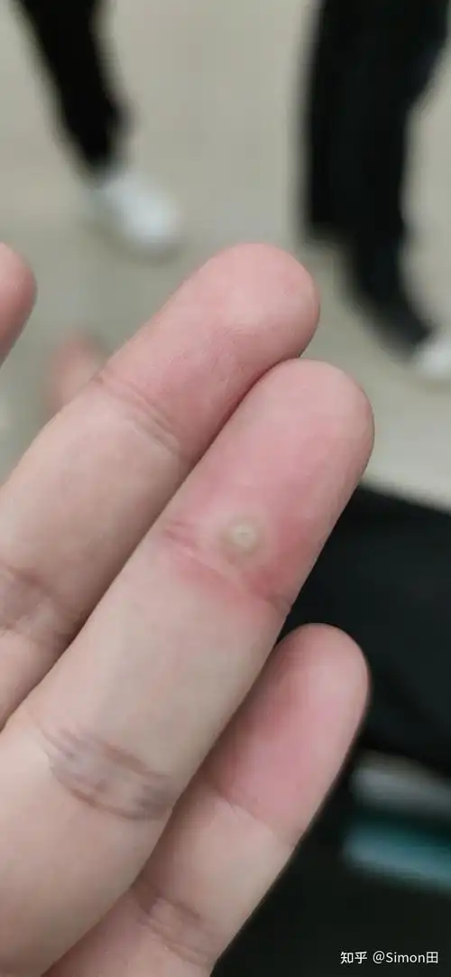 跖疣治疗过程记录 - 知乎