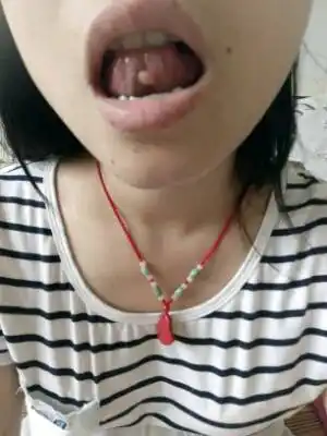 孕中期,舌头下面起了个泡,一个星期了,不会消,也不烂,越来越大,又不能