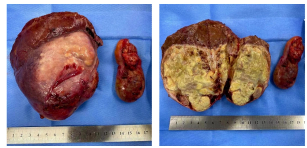 灌注化疗联合免疫治疗成功转化晚期肝癌病例分享_肝癌_肝癌治疗方式