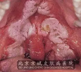 女性梅毒急性皮损的症状