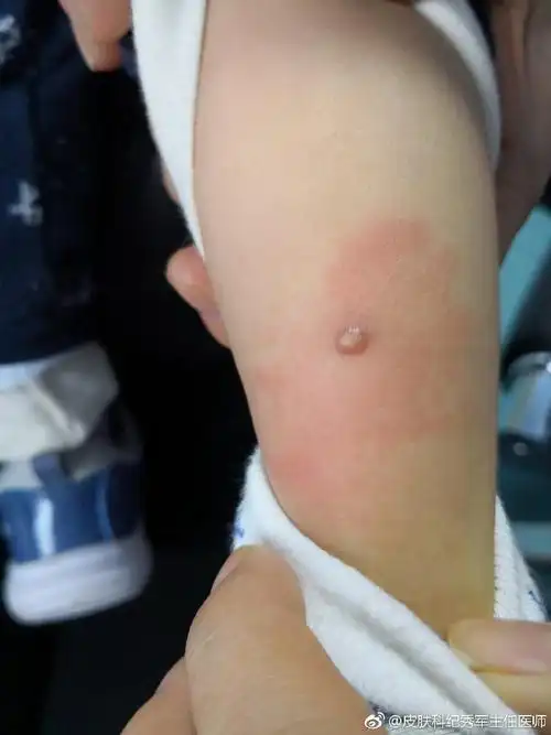 我的患者,儿童,女,1.5岁传染性软疣.