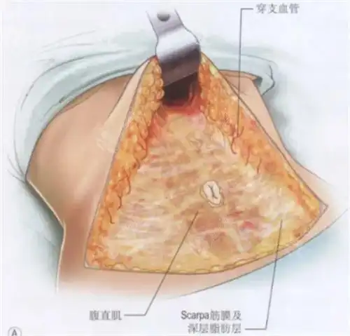 腹壁成形术有几种方案分享腹壁整形的几种切口图及术式参考