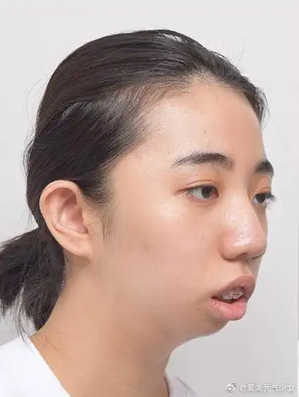 厦门#上下颚手术/突嘴矫正#案例:我原来嘴巴很突出,就显的我很丑,一直