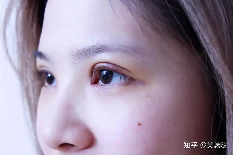 刚割完双眼皮是不是都特丑啊? - 知乎