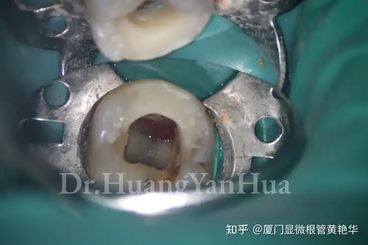 龋坏的牙洞内长息肉治疗牙髓息肉一例