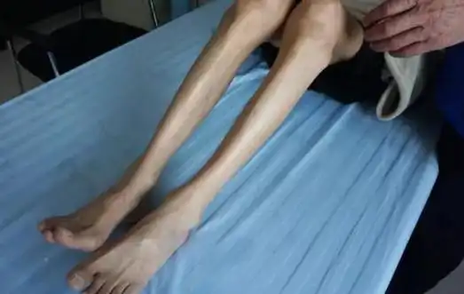 在众多肌肉萎缩类型当中,小腿肌肉萎缩是较常见的一种,此类疾病会导致
