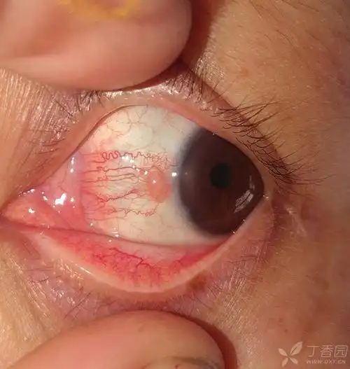 各位老师这个是泡性角结膜炎吧,用药效果不明显,患者也没什么感觉