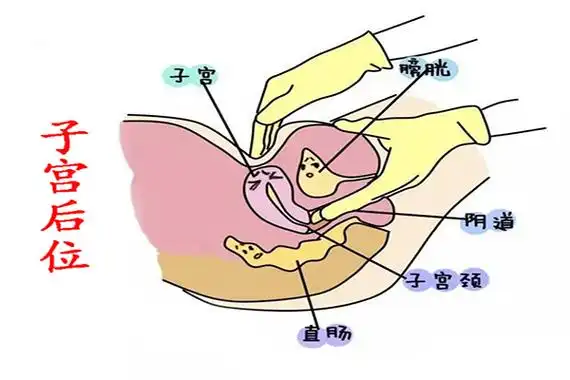 三分带你读懂什么是子宫后位(生殖科普)