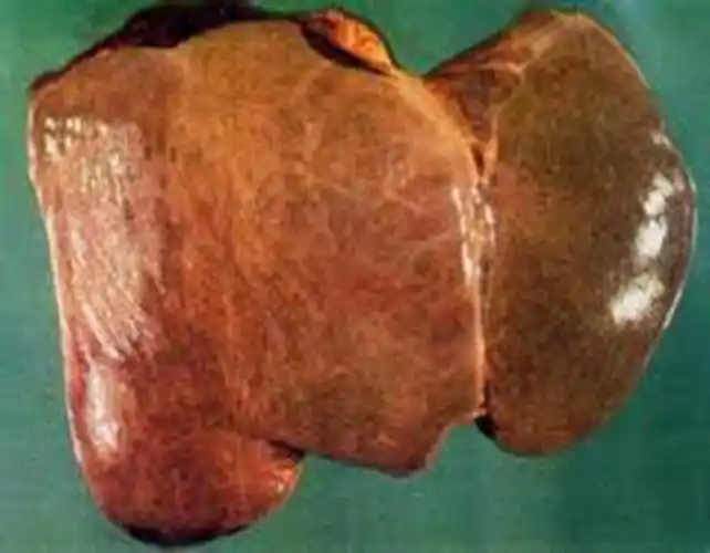 酒精肝的损伤症状的图片