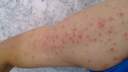 艾滋病红斑图片 (59)