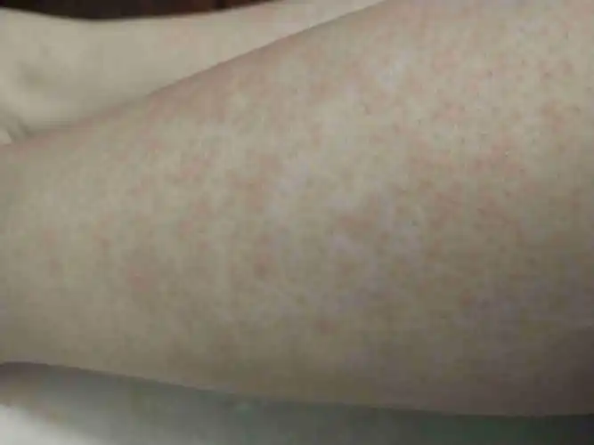 皮肤过敏出红疹,而且超级痒,要擦什么药?