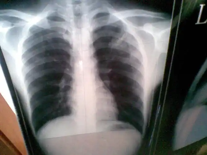 因为工作要去体检 结果检查说有左上浸润型肺结核.