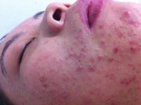 脸上螨虫超标时,会有4个迹象非常明显,教你3招螨虫阵亡