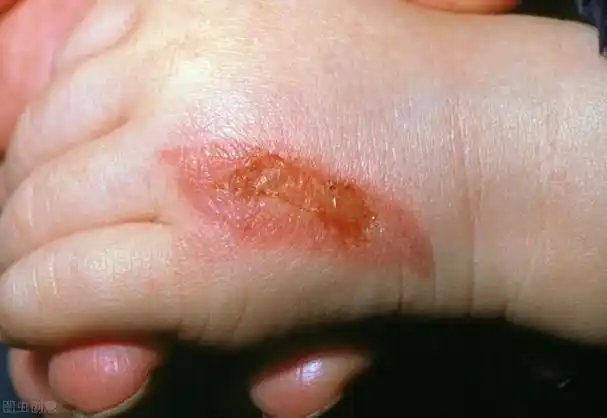 轻微碱烧伤图片,轻度烫伤图片(10岁女儿玩火碱重度烧伤)