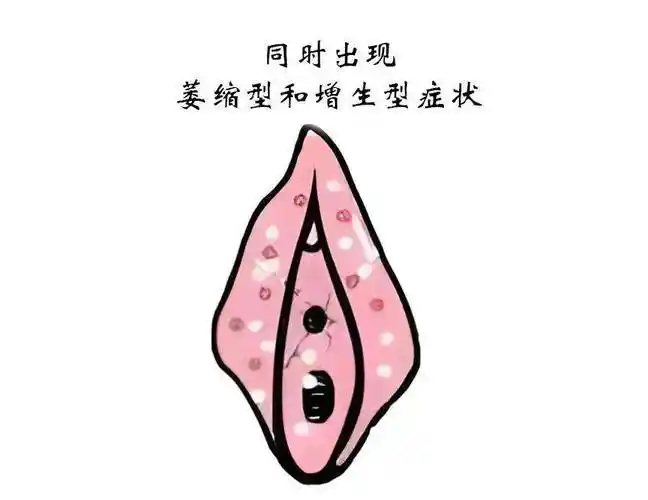 总的来说,因为外阴白斑疾病的不同阶段的病理变化和临床表现不同,所以