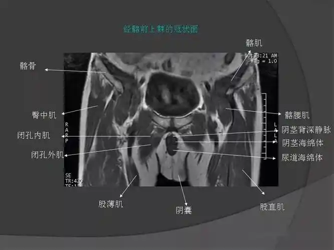 骨盆肌肉解剖mri标识