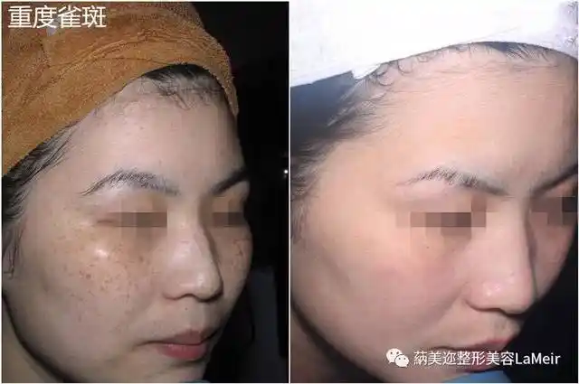 激光祛斑后"反黑"了?快来看你是哪种情况