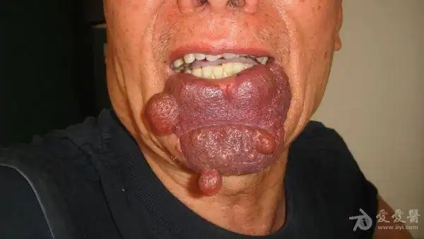 长在嘴部的混合型血管瘤
