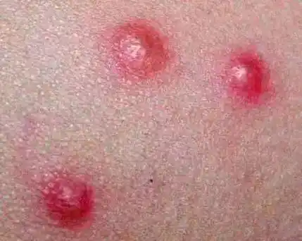 身上出现啥样的疙瘩,要去肿瘤科一趟?