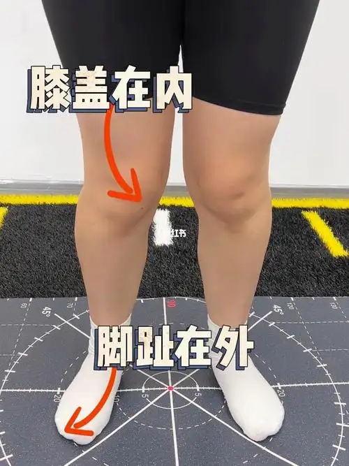 如何改善膝内扣防止膝盖损伤