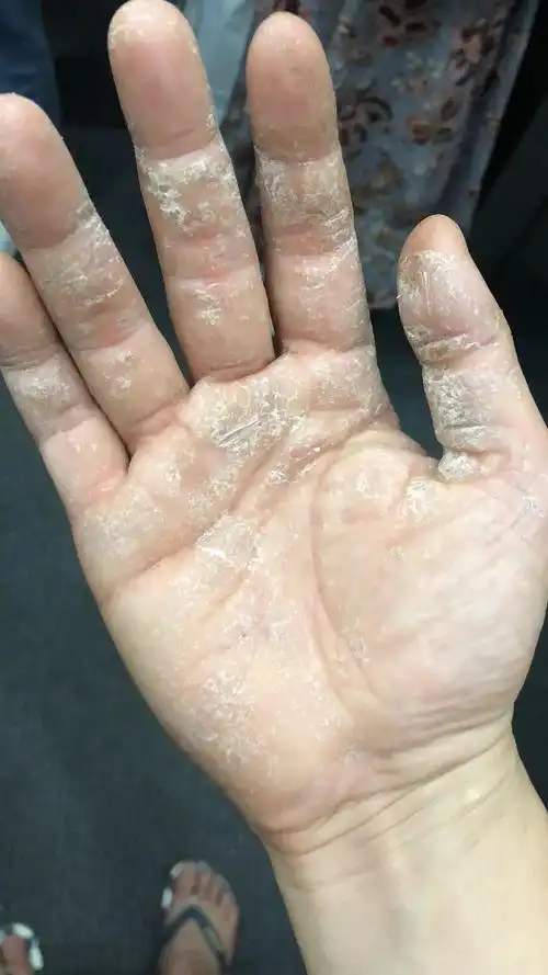 慎看图皲裂性湿疹的我慢慢失去了信心