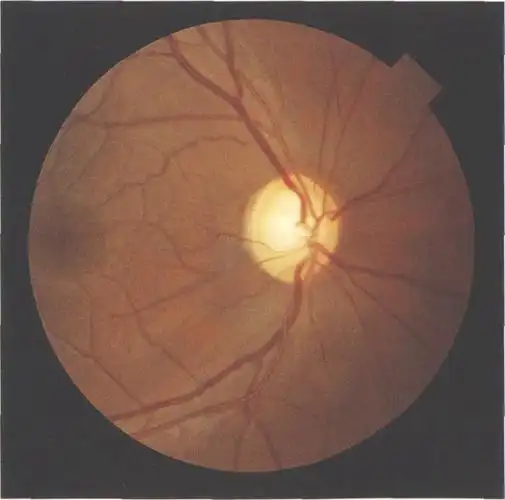 (图) 眼球钝挫伤后视神经萎缩