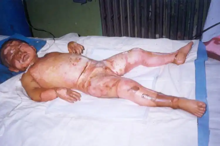 病例一,4 岁,回族,95%全身大面积烧伤深Ⅱ度45%,深Ⅲ度40%,浅Ⅲ度10%