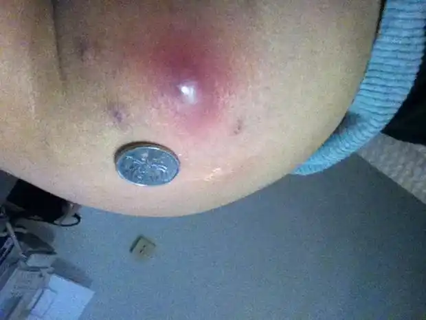 屁股上长了一个巨大的痘痘,怎么办?是什么东西?