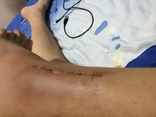 腓骨骨折二十来天了,上钢板处开头有一个小坑是怎么回事,是钢板原因