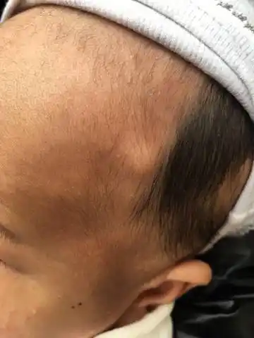 宝宝一出生头上就有个硬小包,现在两个月了 ,好像也没有长大,也没有