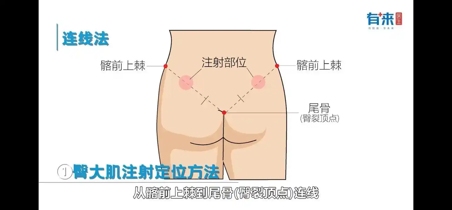臀部肌肉针注射部位 - 抖音
