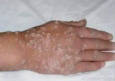 治疗2个多月,疣体全部脱落,未再复发而愈.