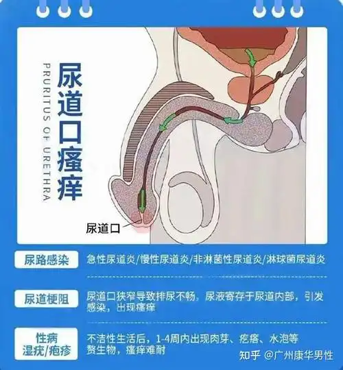 什么是男性滴虫性尿道炎-番禺男科科普