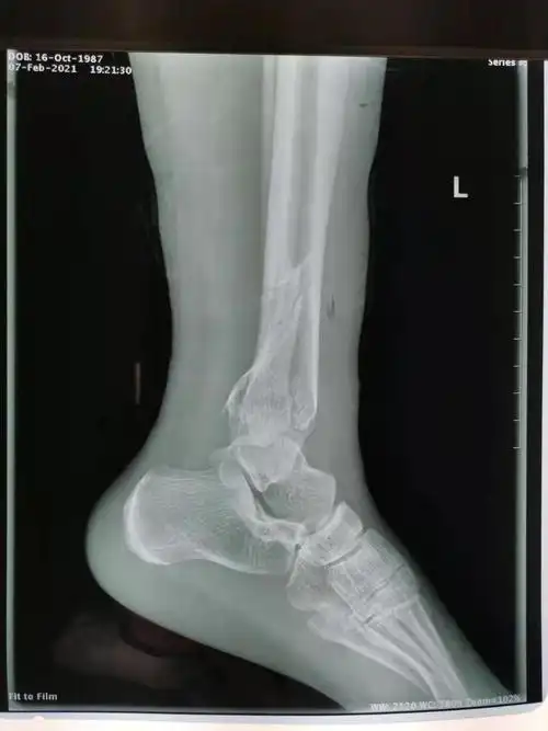 胫腓骨远端骨折双钢板内固定病例