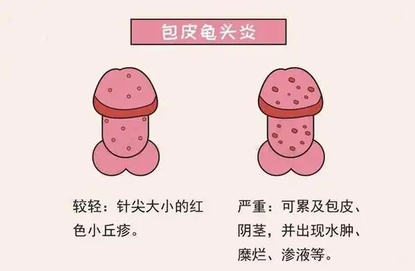 淋病的症状是什么 引发淋病的根本原因有哪些