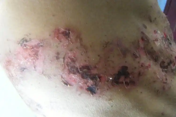 发几张快治愈的带状疱疹的图片(附恢复的照片)