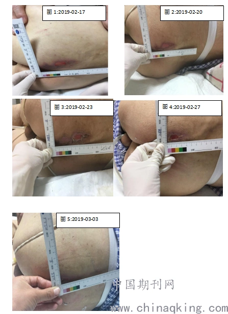 一例骶尾部2期压力性损伤的护理体会